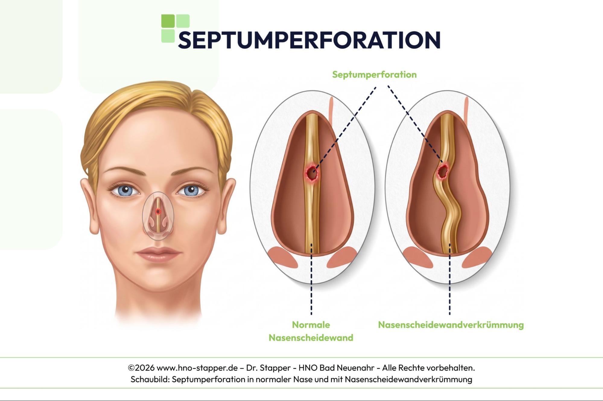 Grafische Darstellung: Septumperforation bei normaler und verkrümmter Nasenscheidewand im Vergleich