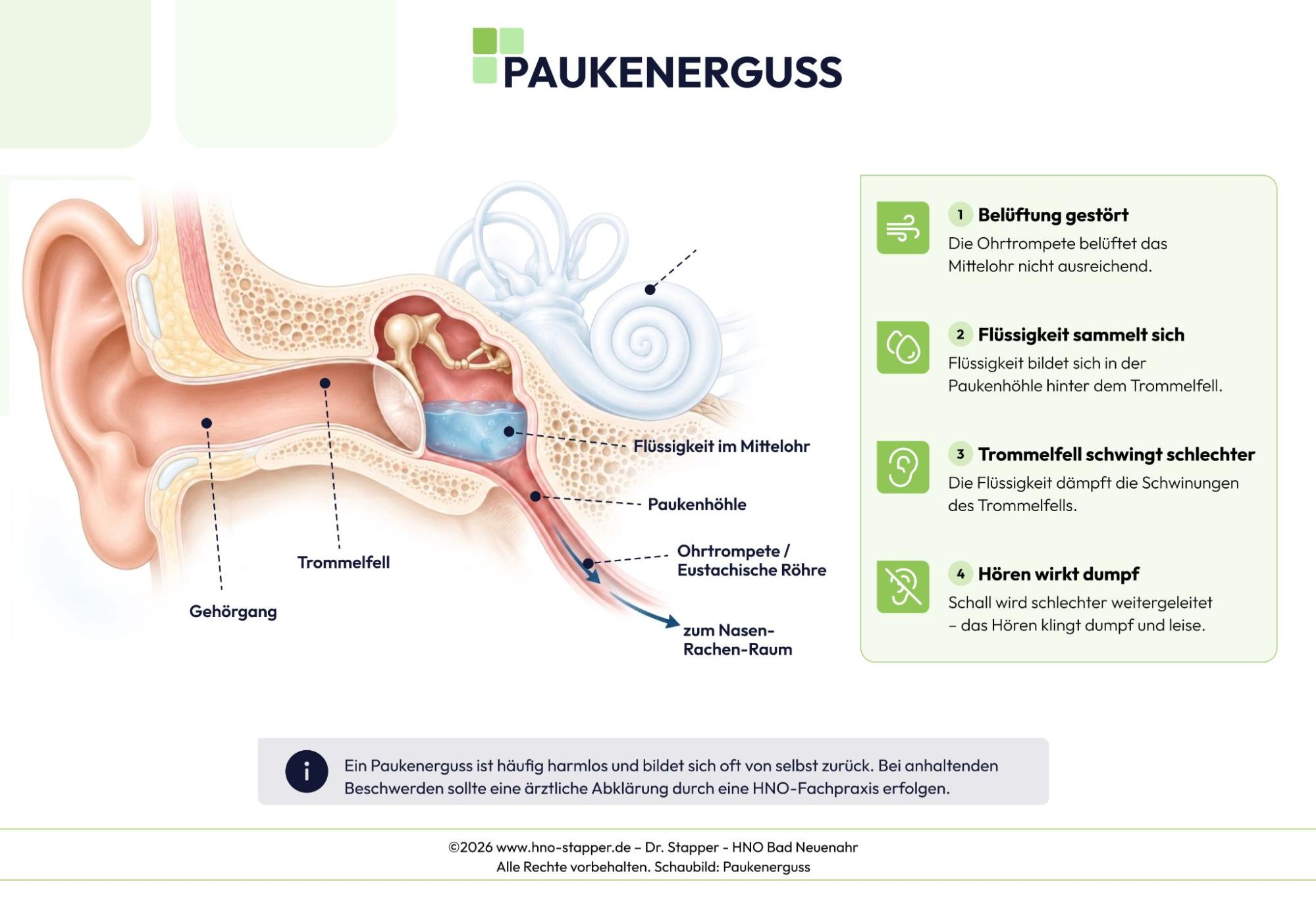 Querschnitt des Ohrs mit Flüssigkeit im Mittelohr bei Paukenerguss hinter dem Trommelfell
